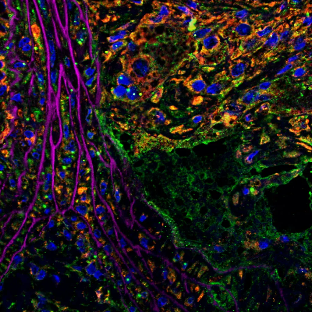 High-magnification immunofluorescence overlay with blue nuclei, magenta fibrous processes, and green and orange signal
