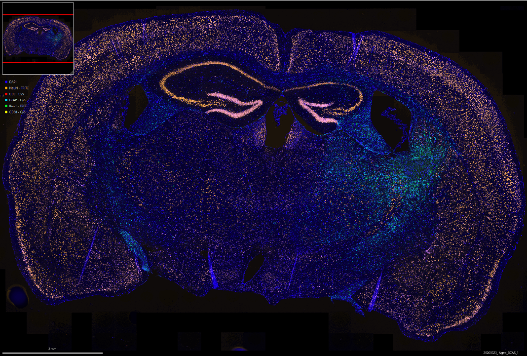 Coronal section of an aged mouse brain imaged by multiplex immunofluorescence. Nuclei are labelled throughout in blue, neurons in orange across the cortex and hippocampus, and a dense cluster of glial signal appears in green and cyan in one hemisphere.
